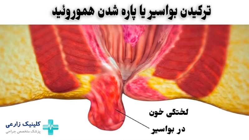 ترکیدن بواسیر خطرناک است؟ علائم و علت پاره شدن هموروئید
