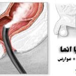 تنقیه چیست | تنقیه خانگی برای یبوست + عوارض استفاده از شلنگ
