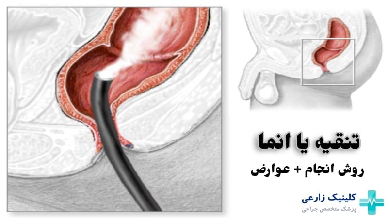 تنقیه چیست | تنقیه خانگی برای یبوست + عوارض استفاده از شلنگ