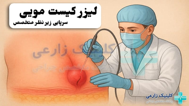 عکس درمان کیست مویی با لیزر در کلینیک زارعی زیر نظر متخصص