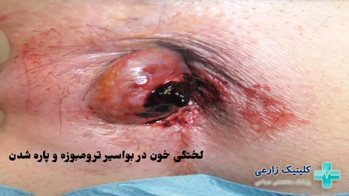 عکس علائم ترکیدن هموروئید