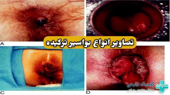 عکس بواسیر پاره شده