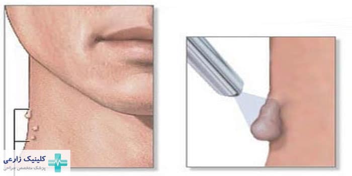 درمان اسکین تگ تناسلی