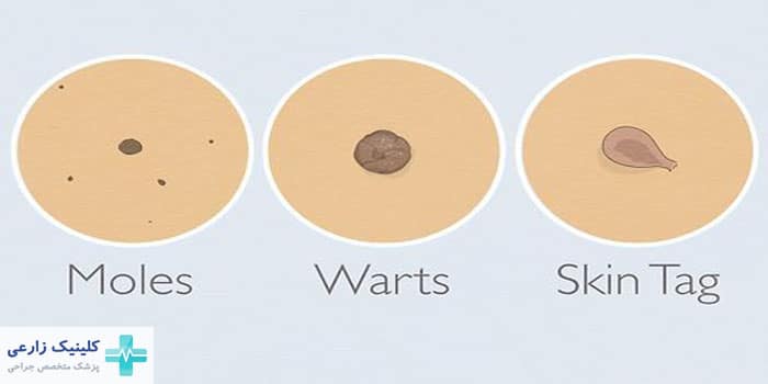 تفاوت اسکین تگ و زگیل تناسلی