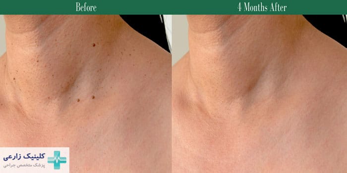 درمان اسکین تگ