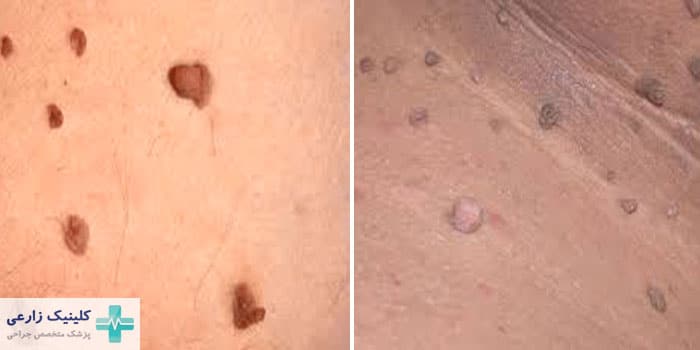 اسکین تگ تناسلی