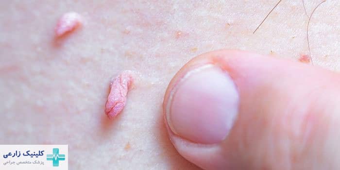 عکس اسکین تگ تناسلی