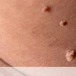 اسکین تگ تناسلی چیست؟ تفاوت با زگیل تناسلی و روش‌های درمان