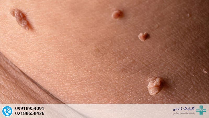 اسکین تگ تناسلی چیست؟ تفاوت با زگیل تناسلی و روش‌های درمان