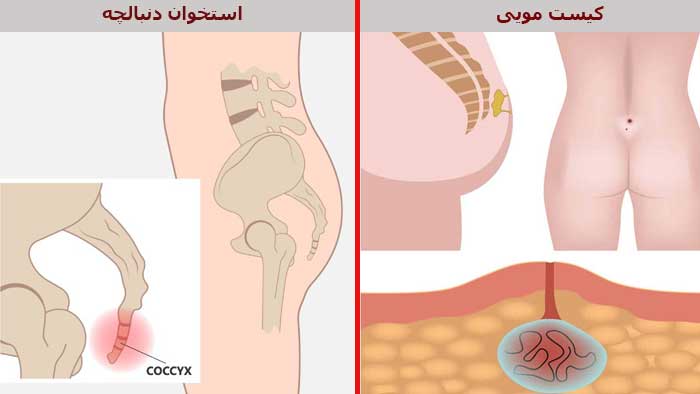 تفاوت درد کیست مویی و دنبالچه